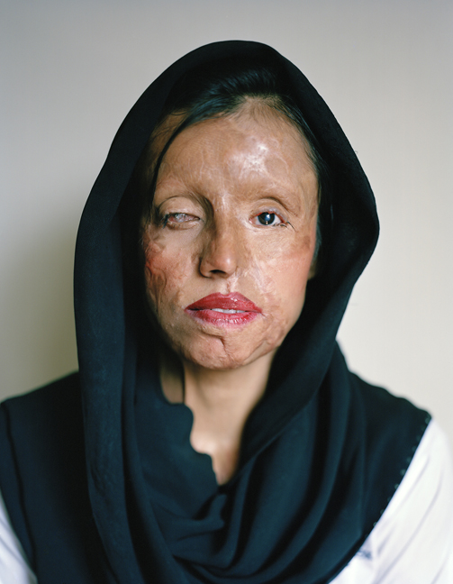 saira laiqat, acid attacks, violence against women, women's empowerment, beauty, women's empowerment