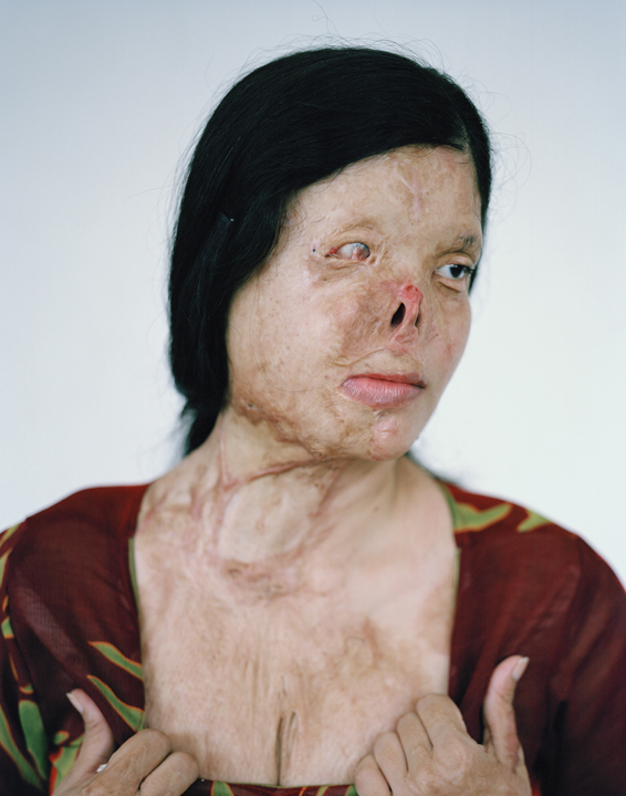 acid attacks, acid violence