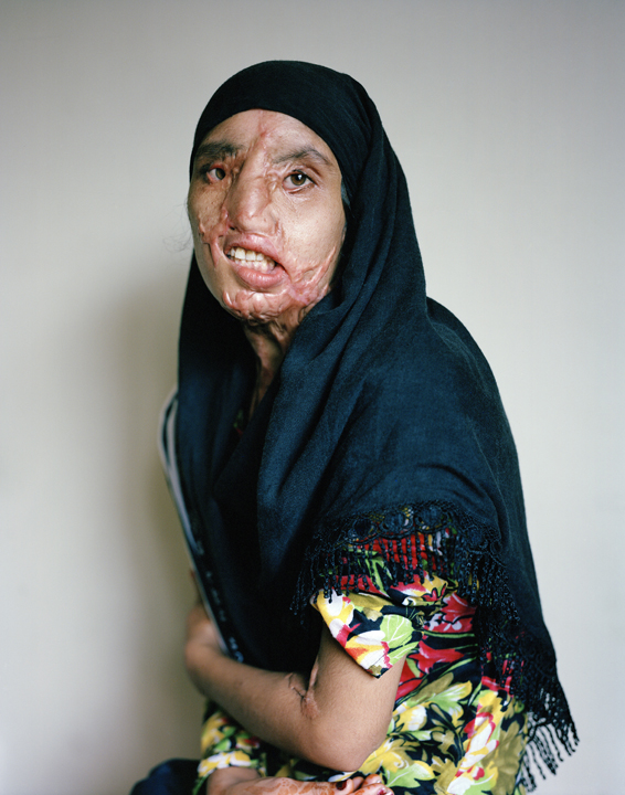 acid attacks, acid violence